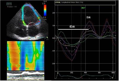 Reversed Apico-Basal Myocardial Relaxation Sequence During Exercise in Long QT Syndrome Mutations Carriers With History of Previous Cardiac Events